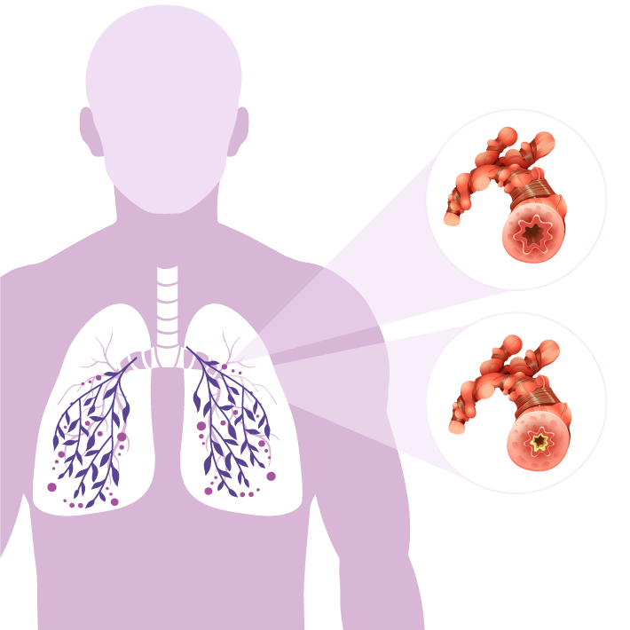 Pulmonary Care